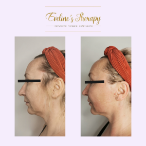 Evelines Therapy Ewelina Kulasik efekty zabiegów przed po facemodeling (3)