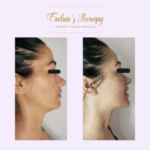 Evelines Therapy Ewelina Kulasik efekty zabiegów przed po facemodeling (5)
