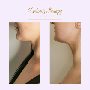 Evelines Therapy Ewelina Kulasik efekty zabiegów przed po facemodeling (6)
