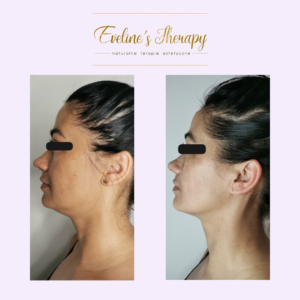 Evelines Therapy Ewelina Kulasik efekty zabiegów przed po facemodeling (1)