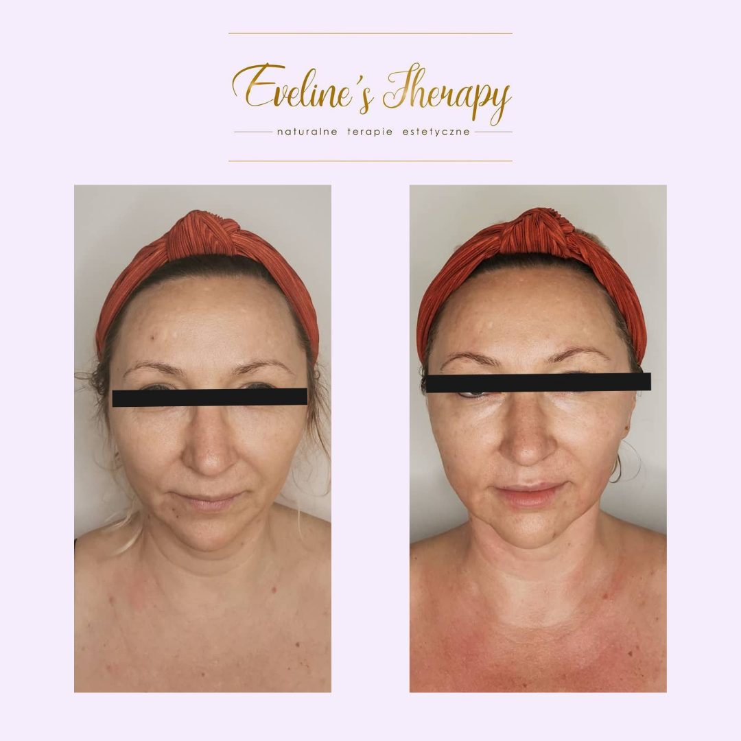 Evelines Therapy Ewelina Kulasik efekty zabiegów przed po facemodeling (2)