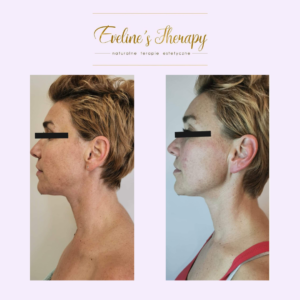 Evelines Therapy Ewelina Kulasik efekty zabiegów przed po facemodeling (4)